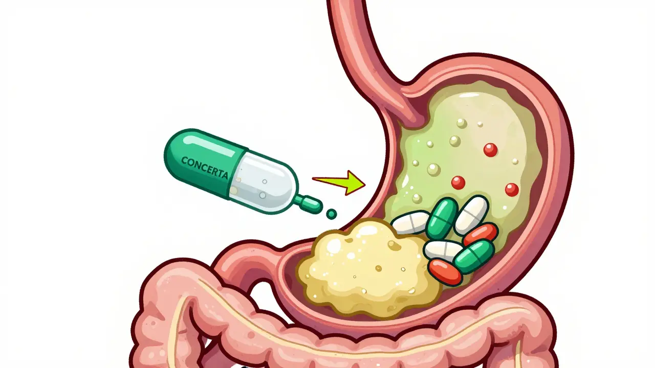 Cartoon stomach showing how different pills release medication around food
